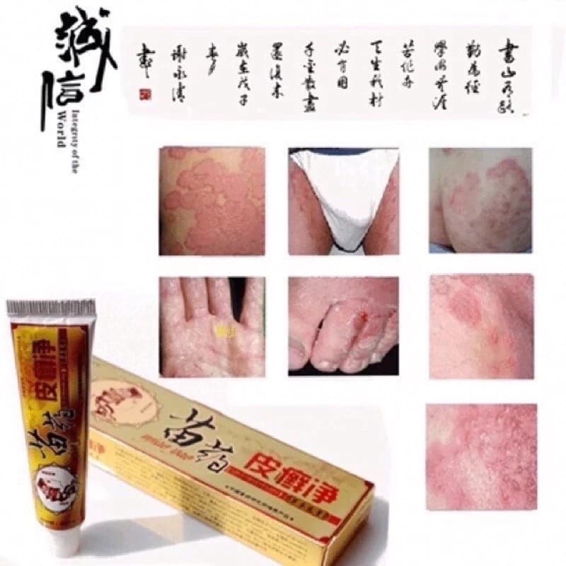 [Miao Vàng] ❤[CHÍNH HÃNG] Kem Bôi Da Liễu - Hắc Lào, Vảy Nến, Mề Đay, Ngứa Nấm, Lang Ben - Có Sẵn
