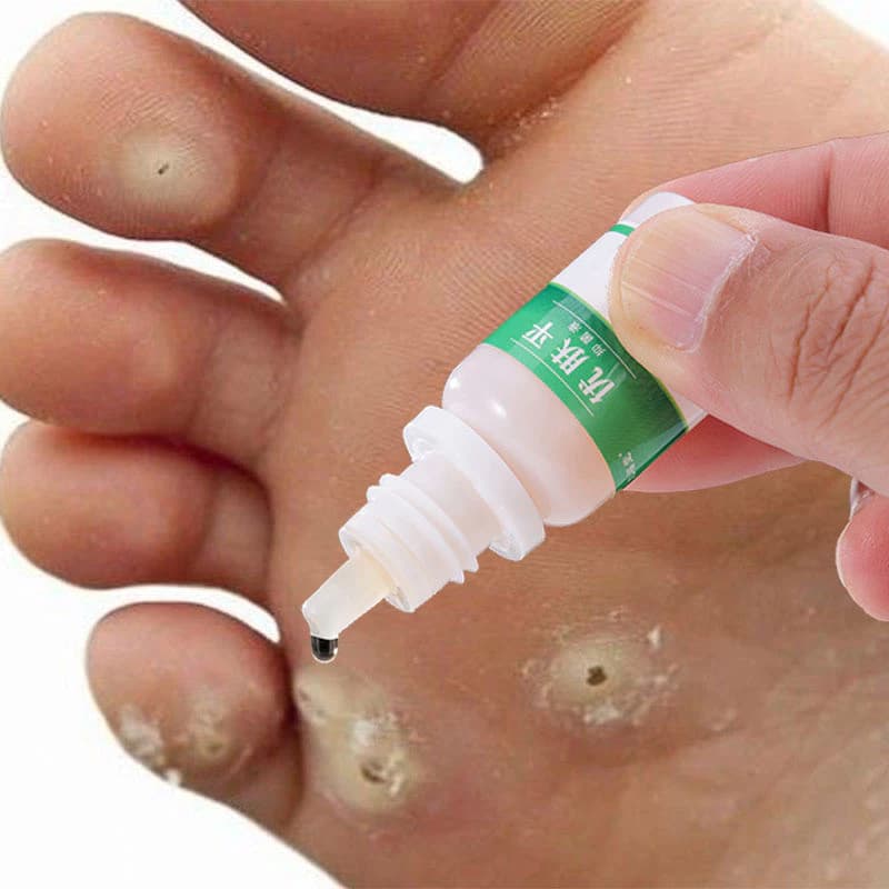 Kem Tẩy Mụn Cóc Kem Tẩy Nốt Ruồi Mụn Cóc 10g 7 Ngày Loại Bỏ Mụn Cóc Nhanh Chóng Loại Bỏ Mụn Cóc an Toàn Và Không Đau