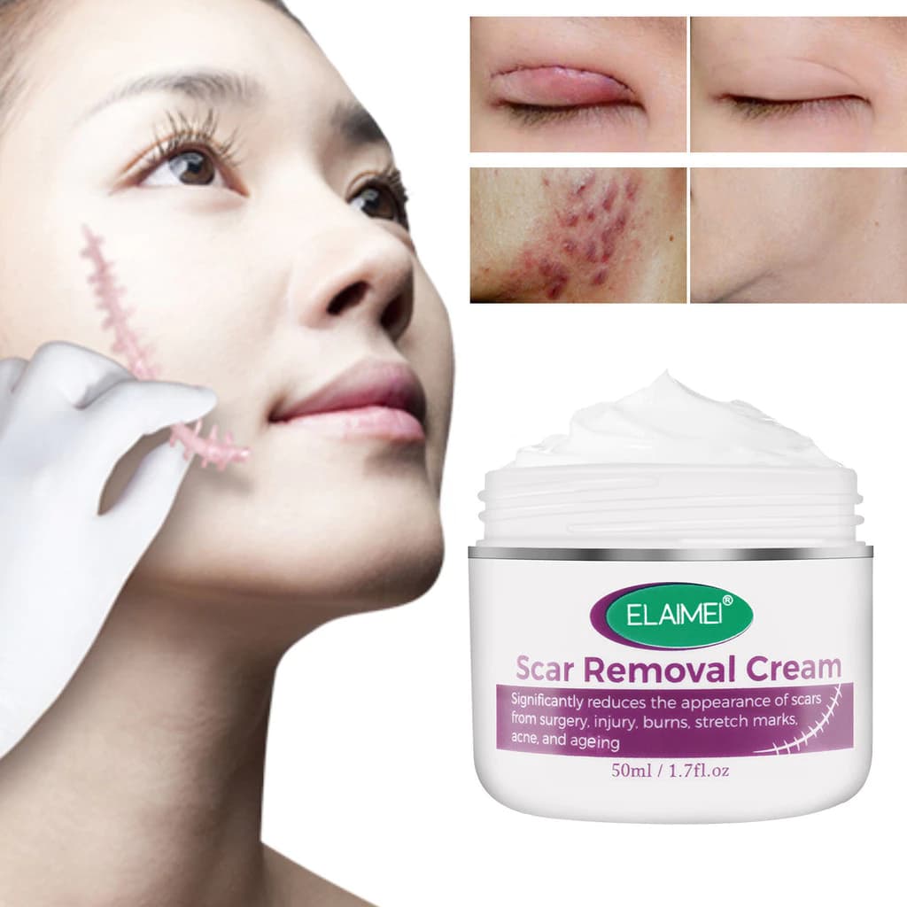 Kem Khử Thâm, Xóa Sẹo Cũ, Loại Sẹo Ở Chân, Sẹo Côn Trùng Cắn, Sẹo Lồi, Sẹo Bỏng, Bỏng Nước